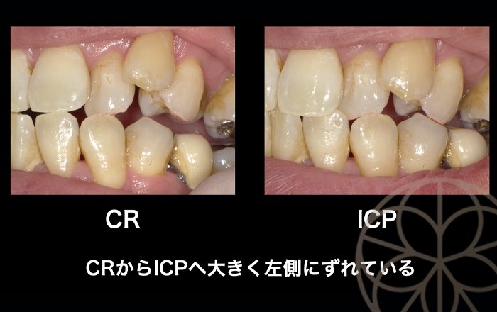 インプラント