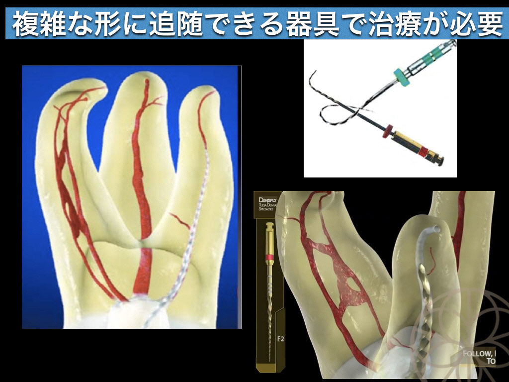 感染根管治療