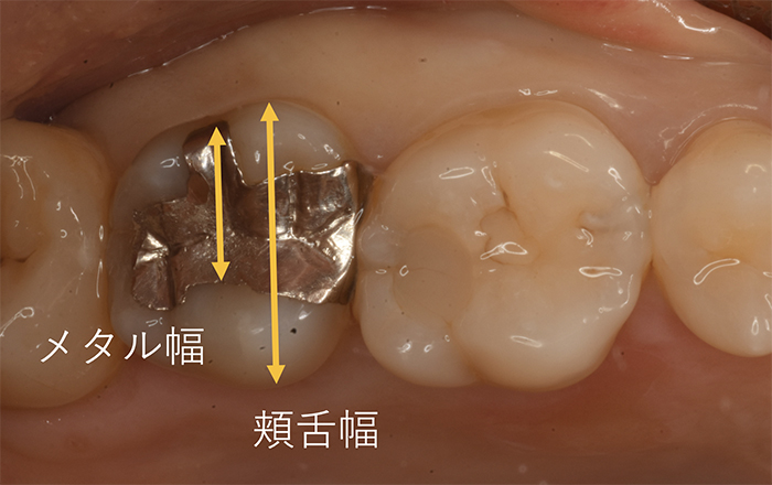 破折を防ぐ