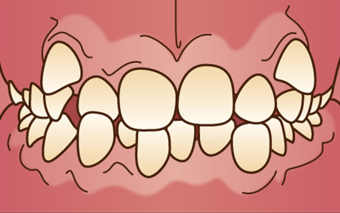 下顎前歯叢生（らんぐい歯）
