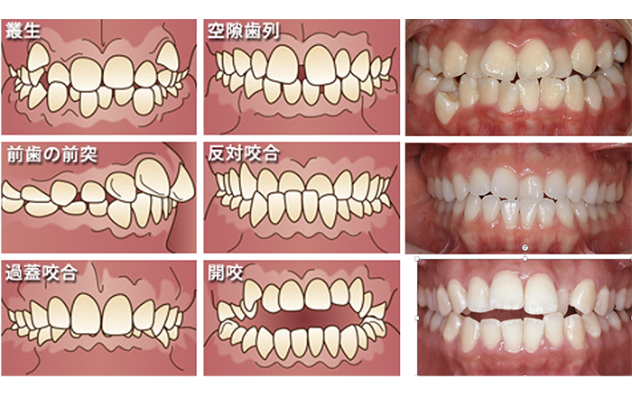 不正咬合の種類