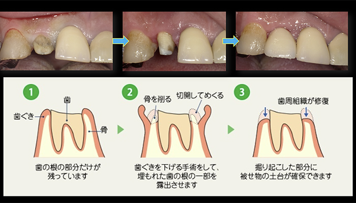 重度歯周病