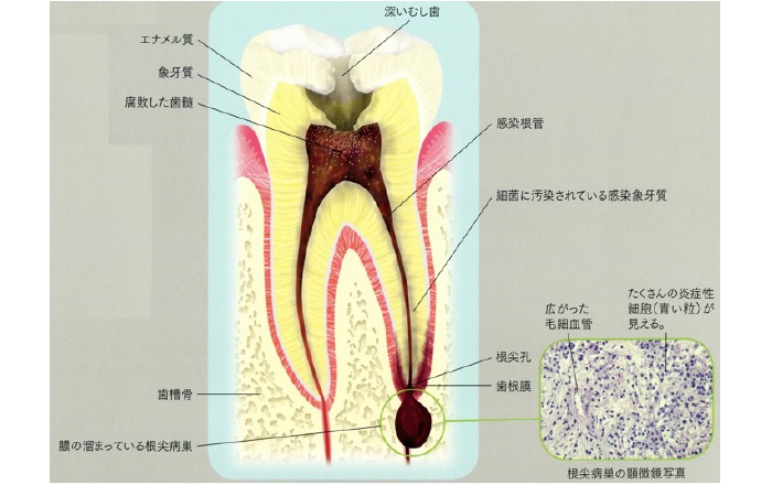 根管治療