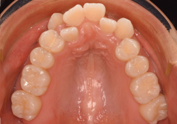 マウスピース矯正