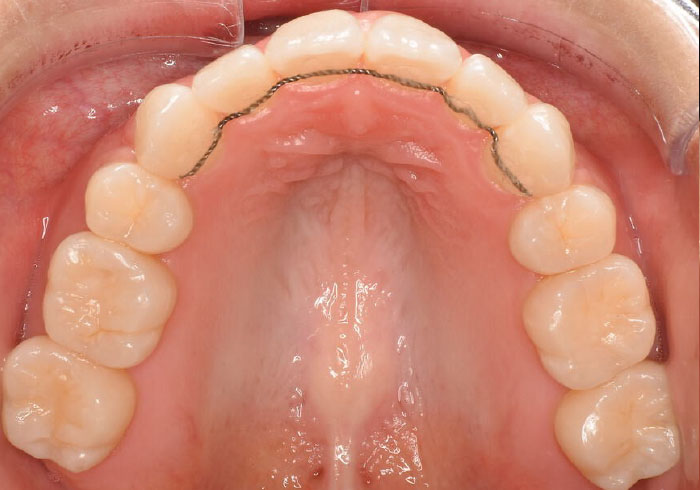 マウスピース矯正