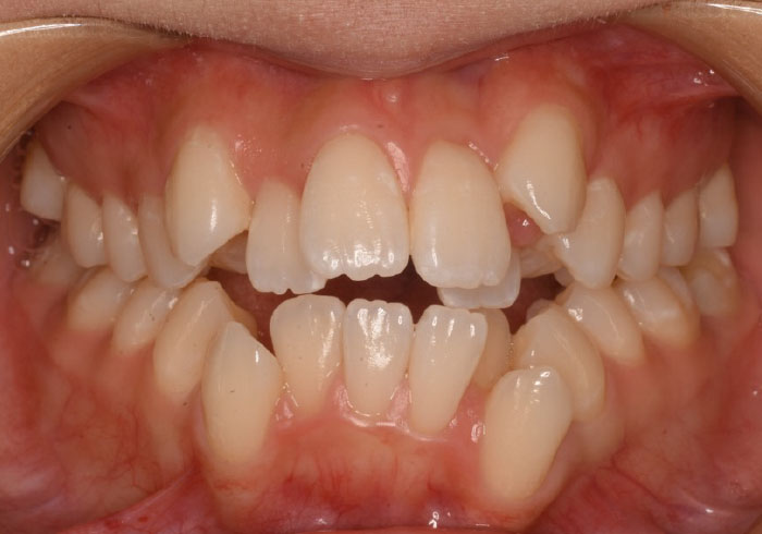 マウスピース矯正