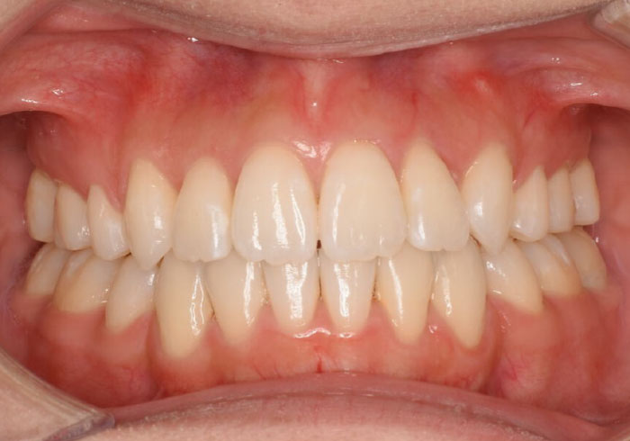 マウスピース矯正