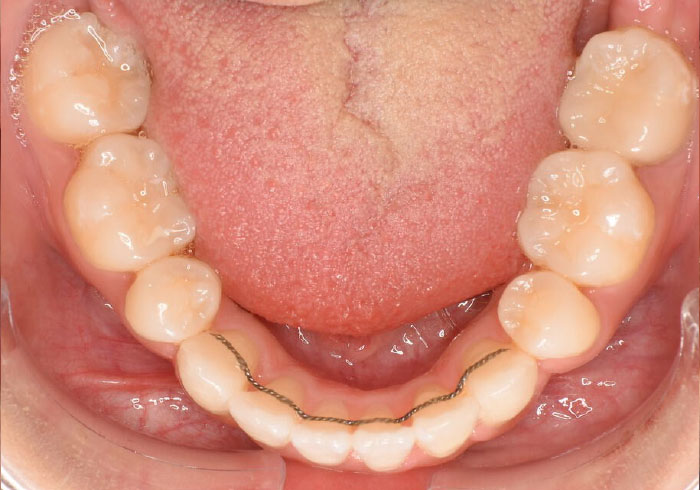 マウスピース矯正