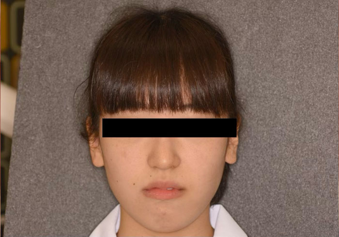 マウスピース矯正