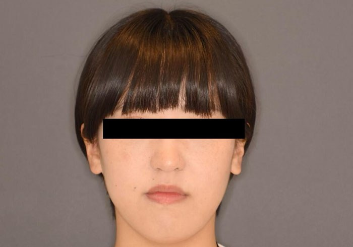 マウスピース矯正