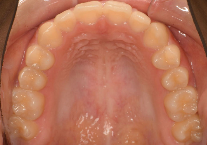 マウスピース矯正