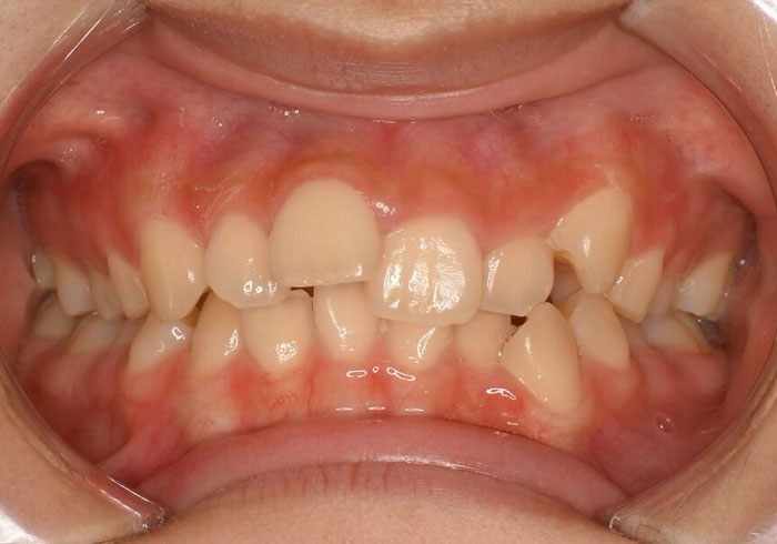 マウスピース矯正