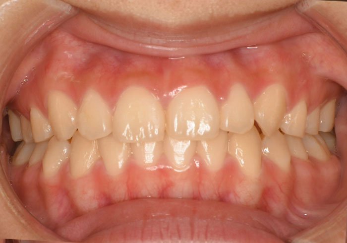 マウスピース矯正