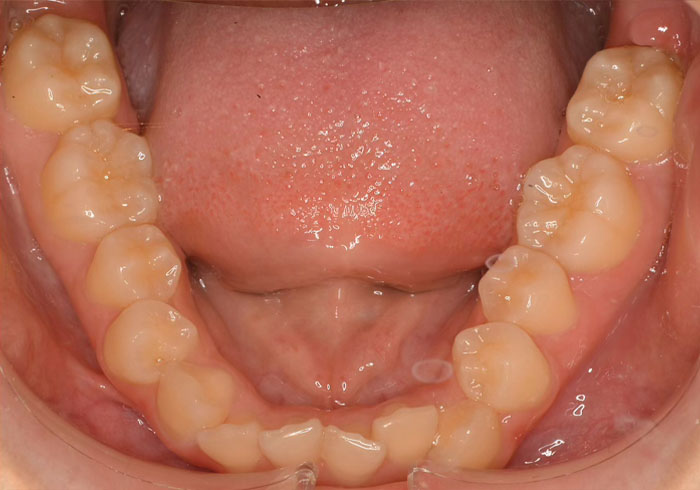 マウスピース矯正