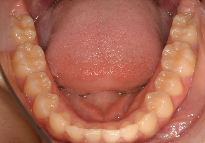 マウスピース矯正