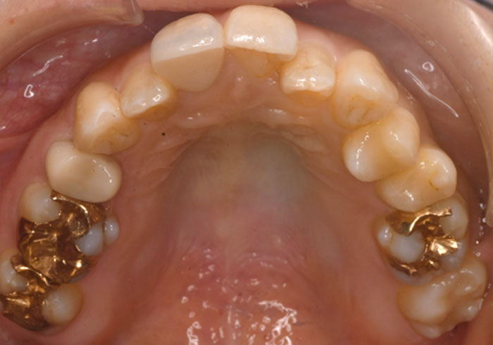 マウスピース矯正