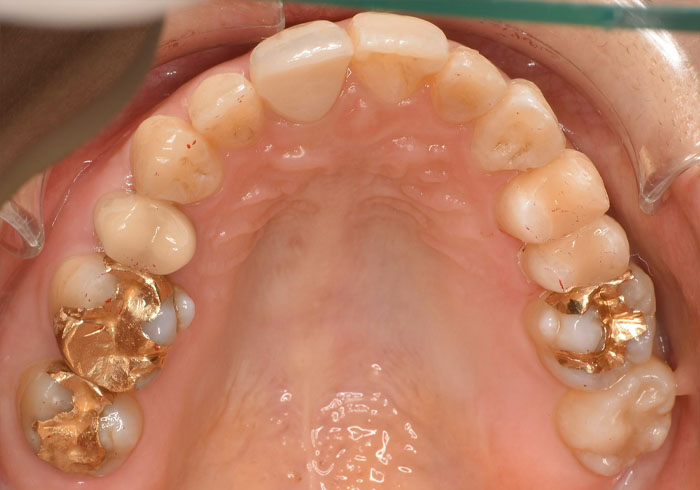 マウスピース矯正