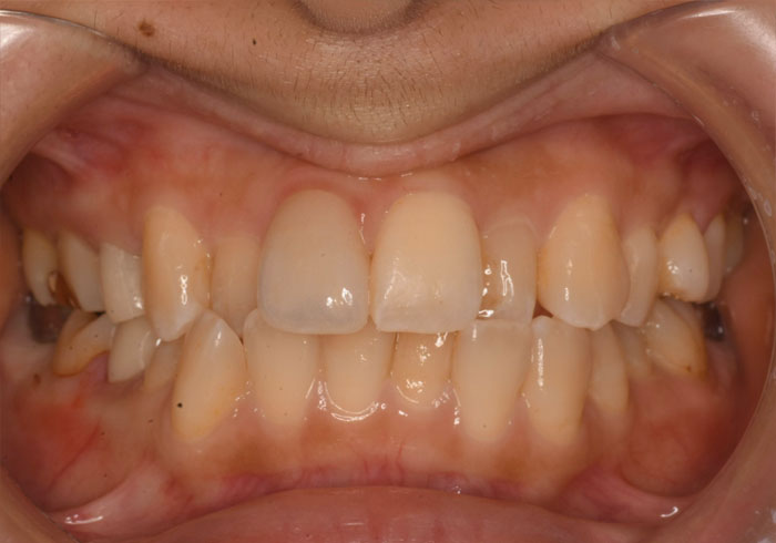 マウスピース矯正