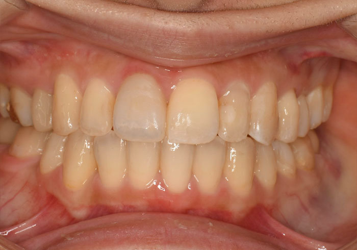 マウスピース矯正