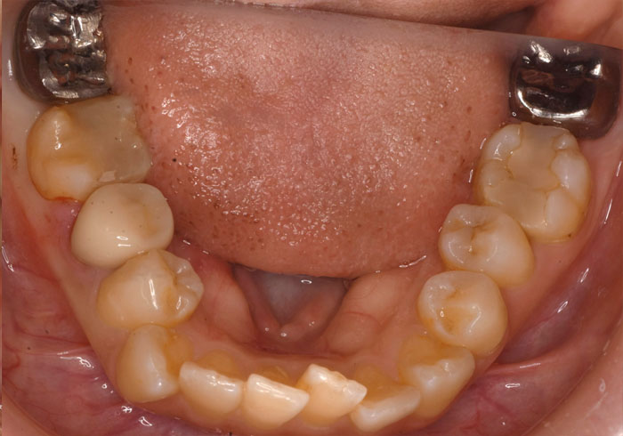 マウスピース矯正
