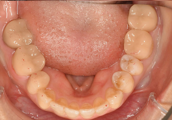 マウスピース矯正