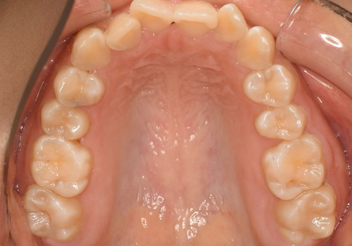 マウスピース矯正