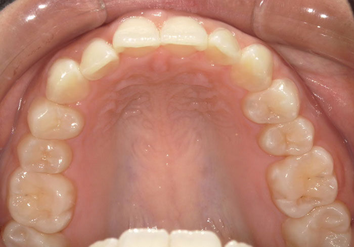 マウスピース矯正