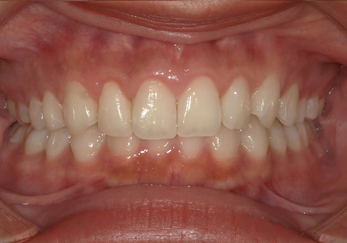 マウスピース矯正