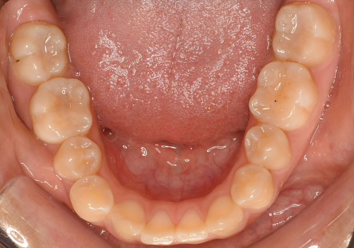 マウスピース矯正