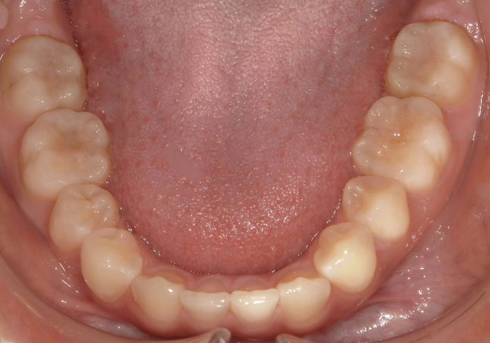 マウスピース矯正