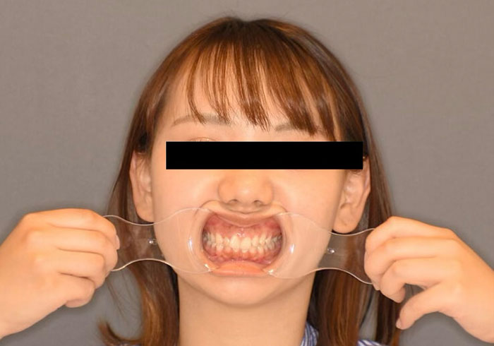 マウスピース矯正