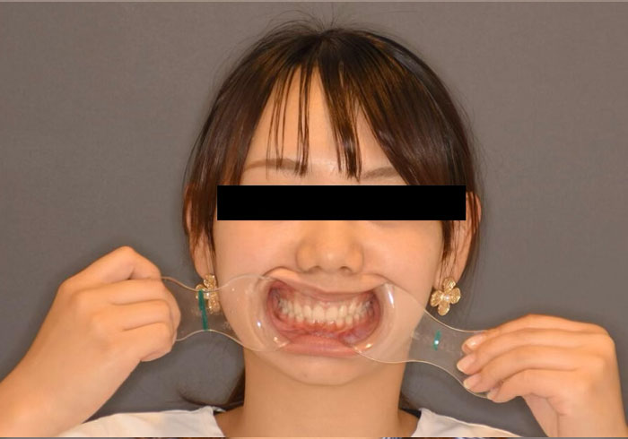 マウスピース矯正
