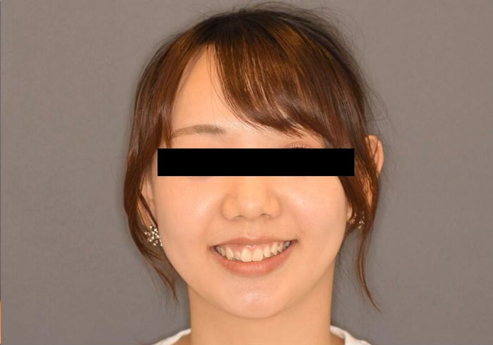 マウスピース矯正