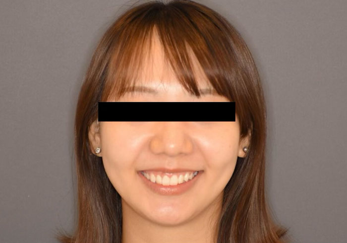 マウスピース矯正