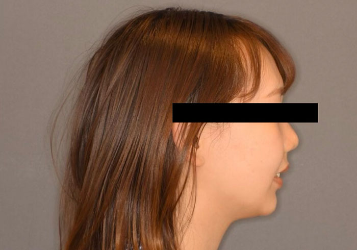 マウスピース矯正