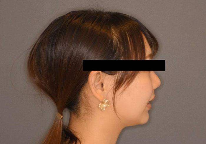 マウスピース矯正