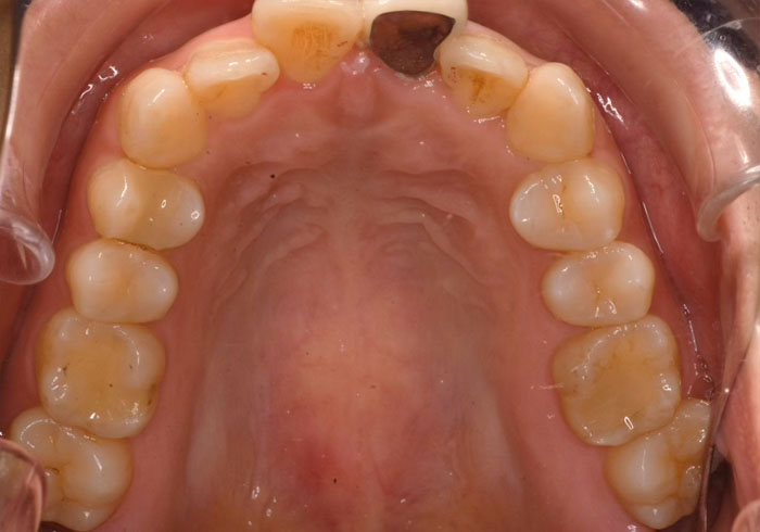 マウスピース矯正