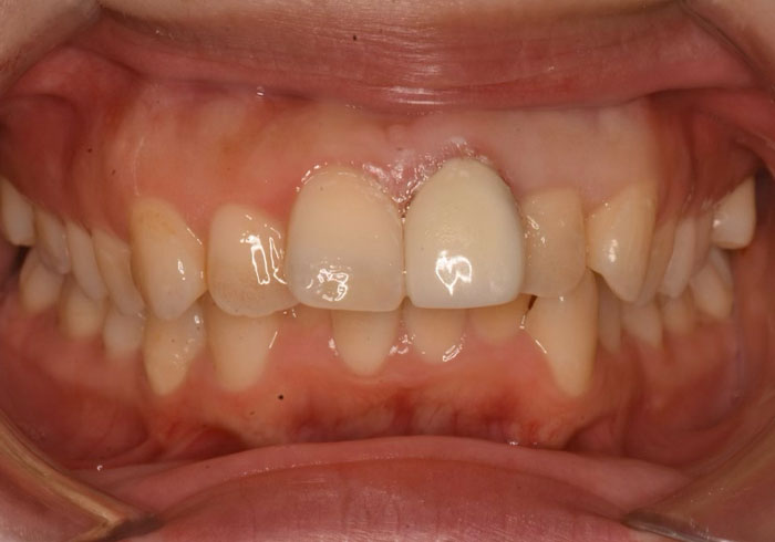 マウスピース矯正