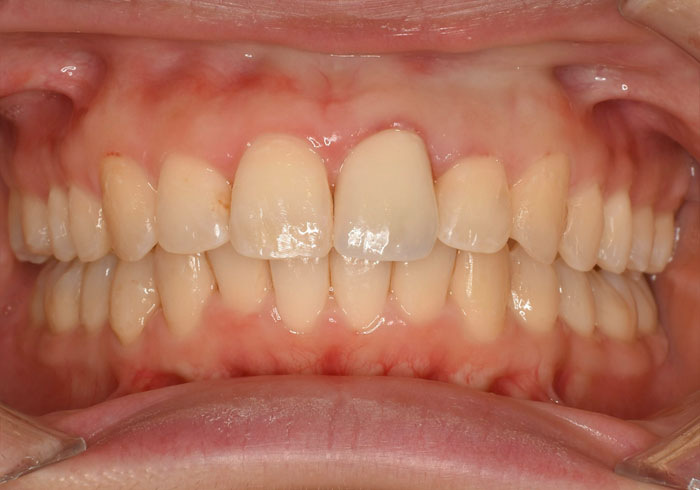 マウスピース矯正