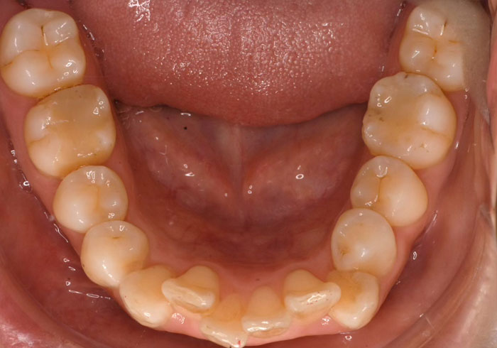 マウスピース矯正