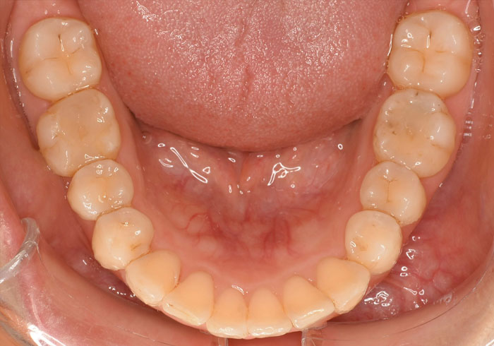 マウスピース矯正