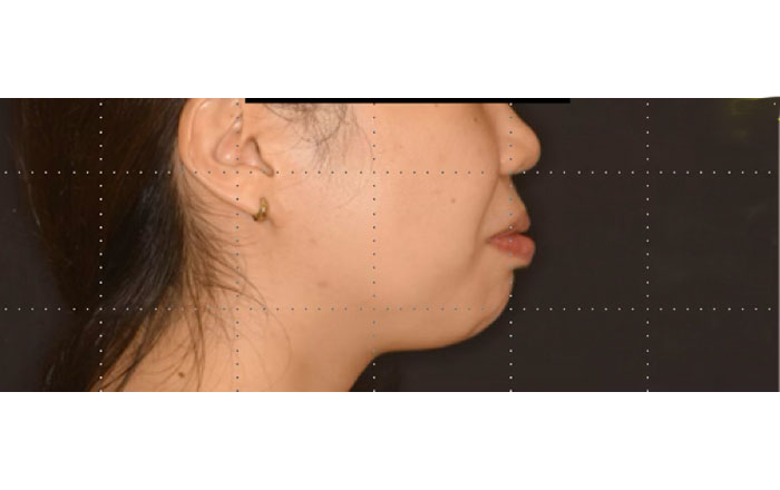 マウスピース矯正