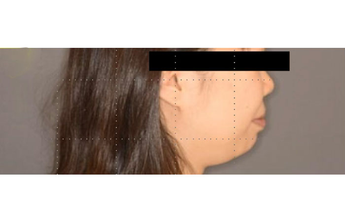 マウスピース矯正