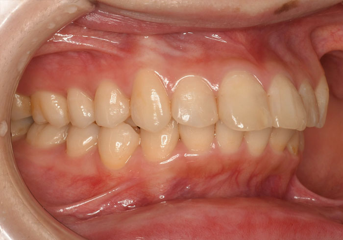 マウスピース矯正