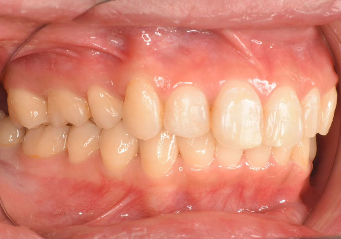 マウスピース矯正