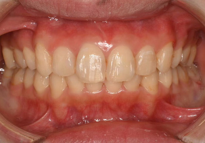 マウスピース矯正