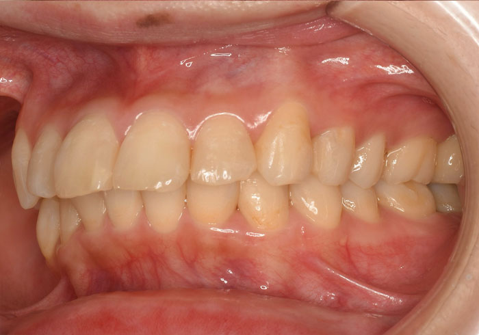 マウスピース矯正