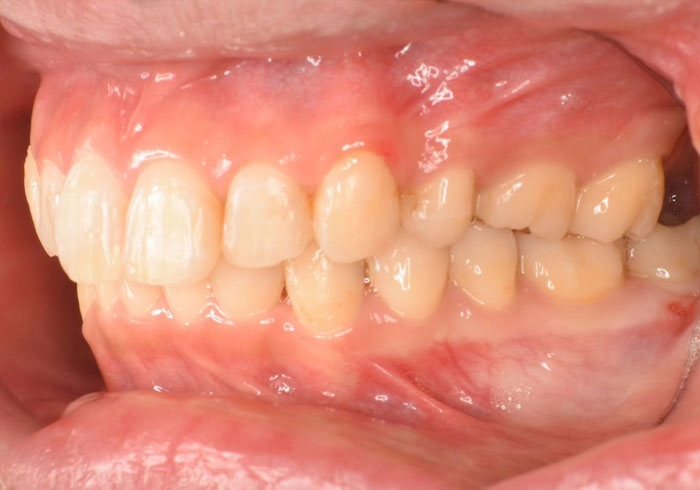 マウスピース矯正