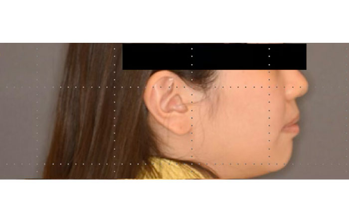 マウスピース矯正