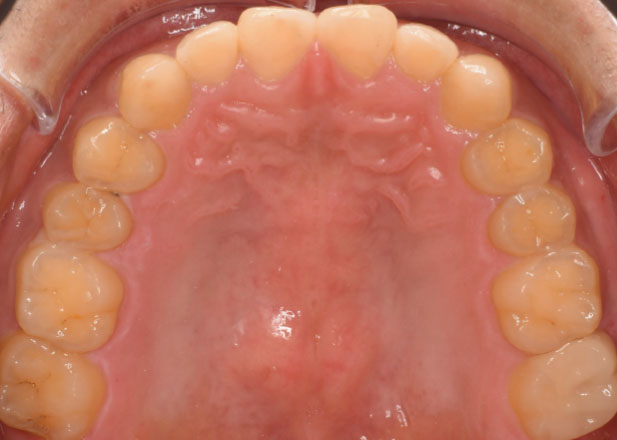 マウスピース矯正